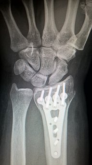 Bone Fixation Plate Testing